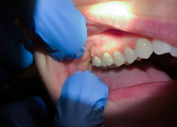 Best Broken or Cracked Tooth Emergency Dentist in Reno, OH