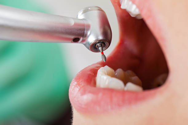 Best Emergency Dentist for Lost Fillings or Crowns in Reno, OH